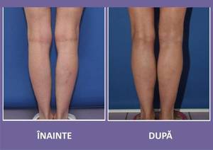 Implantul în gambe, o nouă modă în estetică