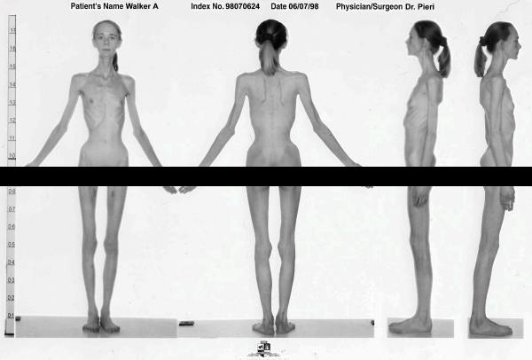 Foto: cum arăta adolescenta de 31 de kilograme