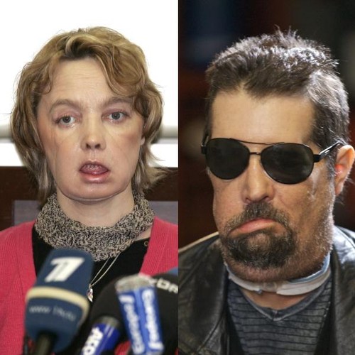 Foto: femeia care şi-a făcut transplant de faţă