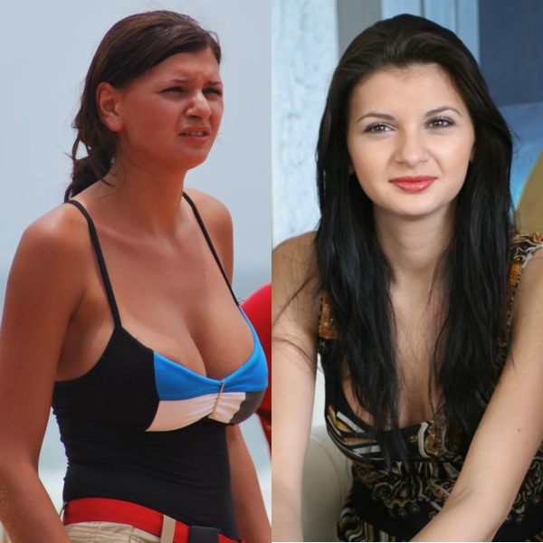 Vedete de la noi: rezultate dezastruoase după operaţii estetice