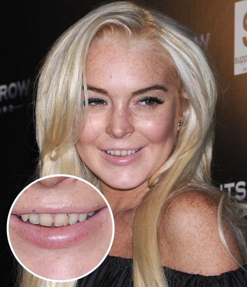 Lindsay Lohan cu dintii galbeni si murdari