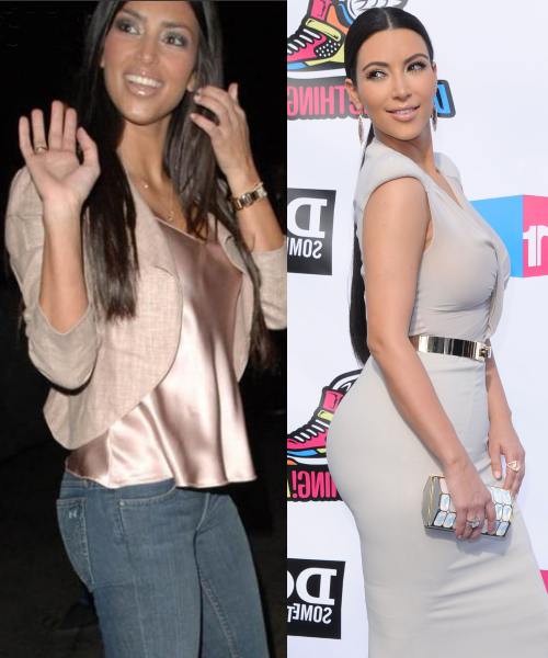 Kim Kardashian si+a facut operatie estetica la fund