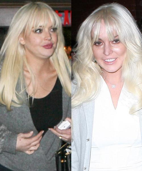 Lindsay Lohan dupa o operatie estetica