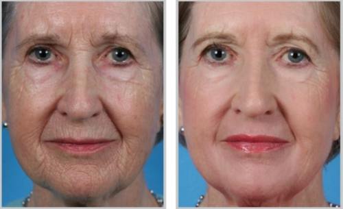 Contour Laser Skin Peel, inamicul cicatricilor şi al ridurilor