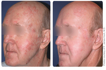 Contour Laser Skin Peel, inamicul cicatricilor şi al ridurilor
