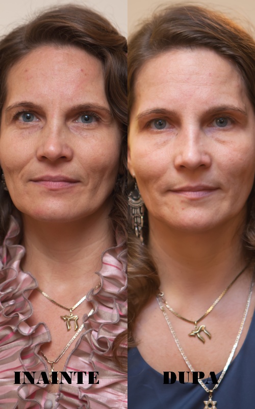 Efectele miraculoase ale injecţiilor cu toxină botulinică! Uite cum arată câştigătoarea!