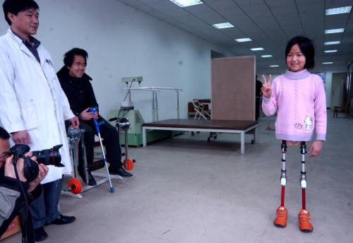 Qian Hongyan, fetiţa cu o minge de baschet în loc de picioare