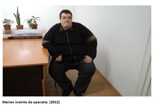 A slăbit peste 100 kg într-un an şi jumătate în urma micşorării stomacului
