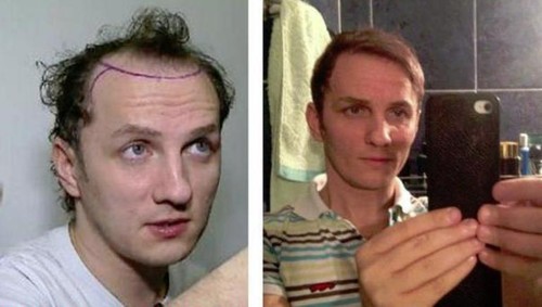 Top 5 vedete de la noi care îşi ascund chelia cu implanturi de păr