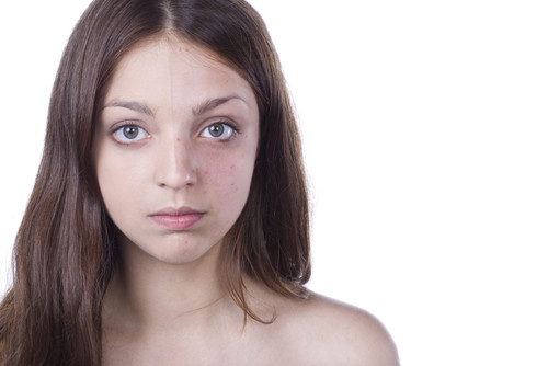 dermatita periorala - ten afecatt de dermatita periorala