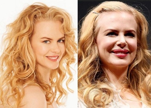 De nerecunoscut! Vedete deformate de botox