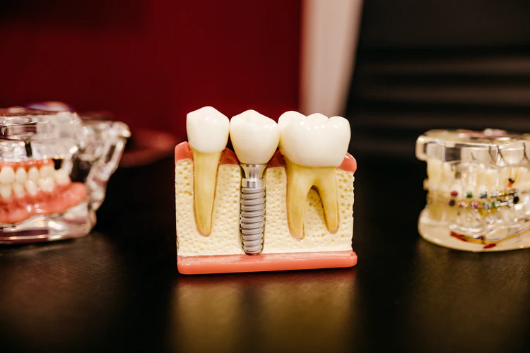 (P) Implantul dentar: calea spre zâmbetul la care ai visat de ceva vreme