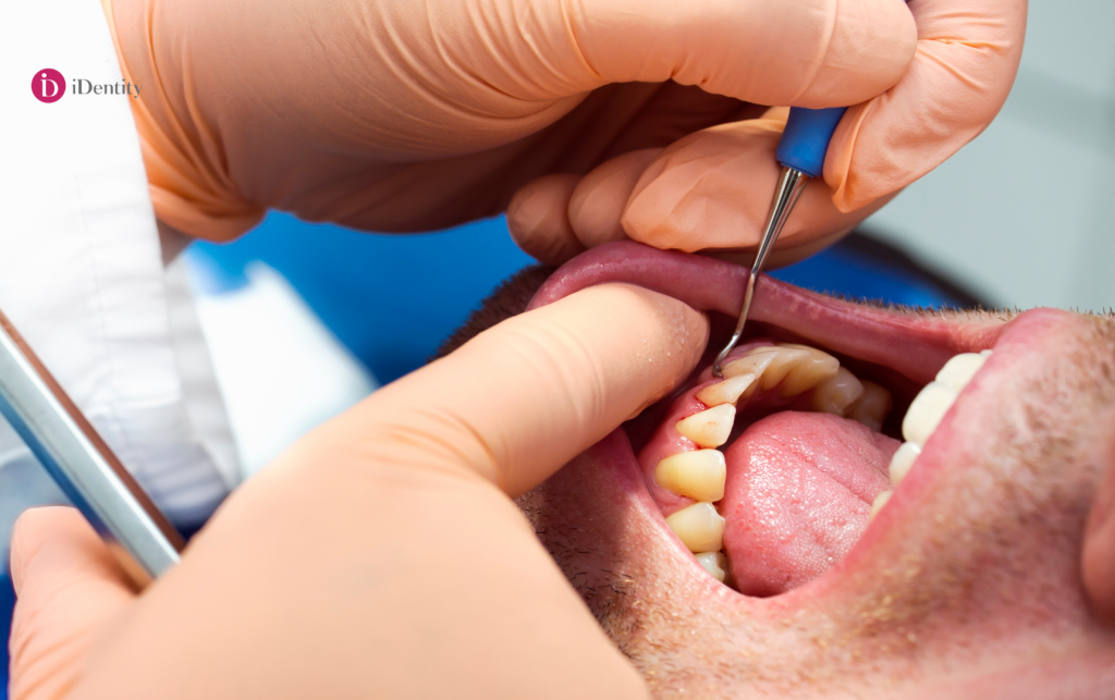 Lupta cu parodontoza: salvează-ţi zâmbetul cu ajutorul implanturilor dentare!