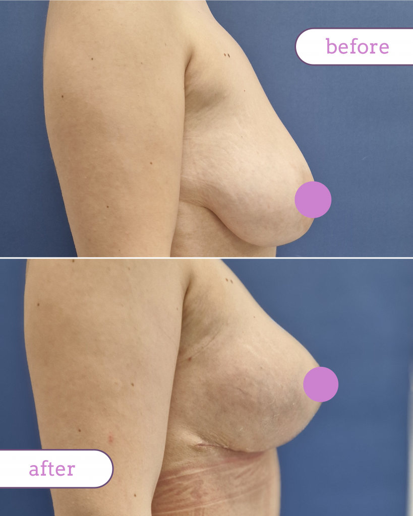 Martie: momentul perfect pentru augmentarea cu implant mamar