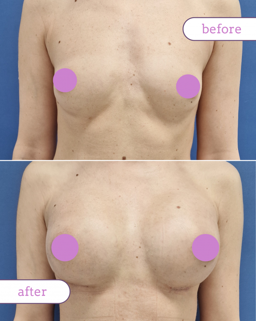 Martie: momentul perfect pentru augmentarea cu implant mamar